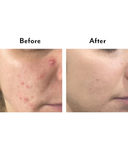 Thera Intensive Clarifying Spot Treatment